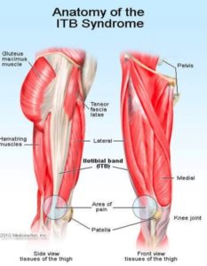 Knee Pain- picture of the IT band